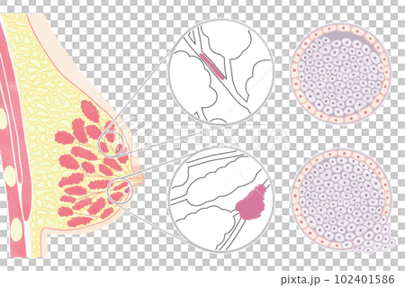 非浸潤性乳管がん(DCIS)と浸潤性乳管がん(IDC)の図解イラスト 非浸潤性乳管がん(DCIS)と浸潤性乳管がん(IDC)の図解イラスト 102401586
