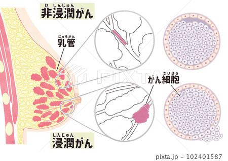 Preast Cancer Breast Cancer Diagram Stages