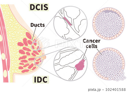 非浸潤性乳管がん(DCIS)と浸潤性乳管がん(IDC)の図解イラスト 非浸潤性乳管がん(DCIS)と浸潤性乳管がん(IDC)の図解イラスト 102401588