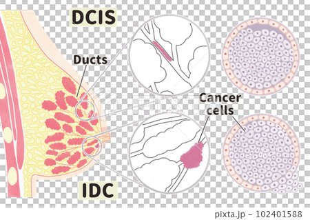 非浸潤性乳管がん(DCIS)と浸潤性乳管がん(IDC)の図解イラスト 非浸潤性乳管がん(DCIS)と浸潤性乳管がん(IDC)の図解イラスト 102401588