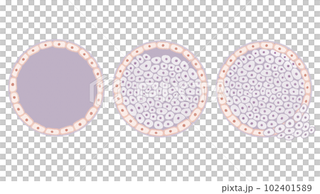 乳がんの発生とステージの図解イラスト 文字なし 乳がんの発生とステージの図解イラスト 文字なし 102401589