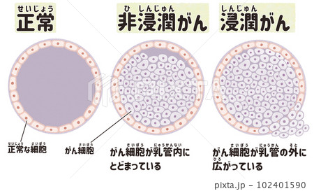 乳がん　非浸潤がんと浸潤がんの図解イラスト 102401590