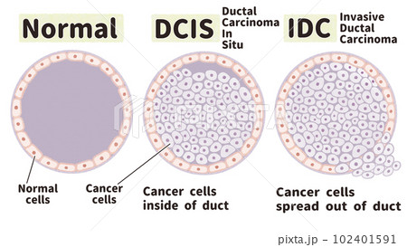 乳がん 非浸潤がんと浸潤がんの図解イラスト 乳がん 非浸潤がんと浸潤がんの図解イラスト 102401591