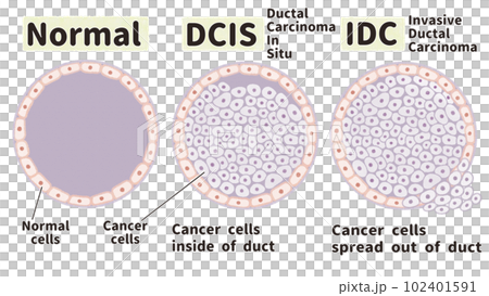 乳がん 非浸潤がんと浸潤がんの図解イラスト 乳がん 非浸潤がんと浸潤がんの図解イラスト 102401591