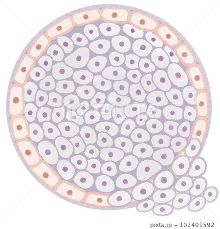 浸潤性乳管癌(IDC)の図解イラスト 浸潤性乳管癌(IDC)の図解イラスト 102401592