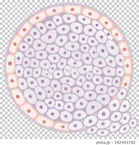 浸潤性乳管癌(IDC)の図解イラスト 浸潤性乳管癌(IDC)の図解イラスト 102401592