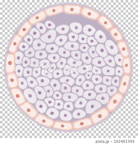 導管原位癌 (DCIS) 示意圖 102401593