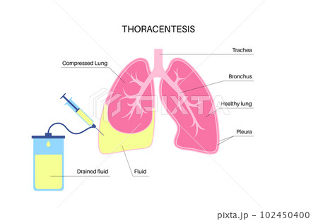 Thoracentesis medical procedure Thoracentesis medical procedure 102450400