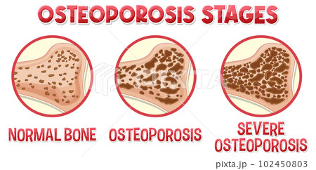 Informative poster of Osteoporosis human bone Informative poster of Osteoporosis human bone 102450803