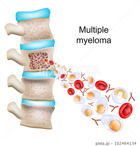 Multiple myeloma. Close-up of Abnormal plasma cells, red blood cells, and antibodies. 102464134