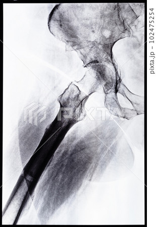 x-ray side view of junction of tibia and pelvis x-ray side view of junction of tibia and pelvis 102475254