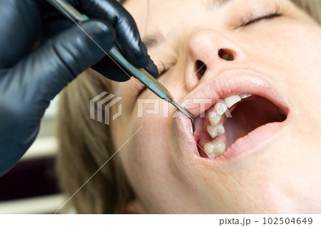 Caries treatment to chewing side tooth upper jaw 102504649