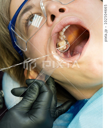 Installation metal clip. Tooth restoration process Installation metal clip. Tooth restoration process 102504665