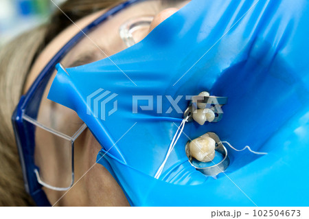 Isolate patient's teeth with rubber pad. Isolate patient's teeth with rubber pad. 102504673