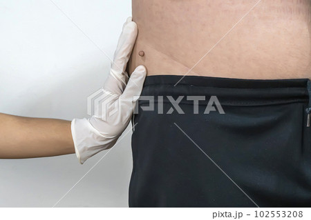 Skin tag or acrochondon or soft fibroma Skin tag or acrochondon or soft fibroma 102553208