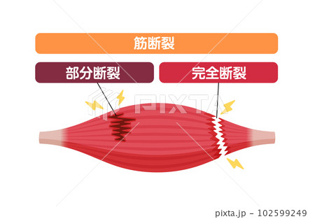筋断裂 (肉離れ) の症状 ベクターイラスト (部分断裂・完全断裂) 102599249