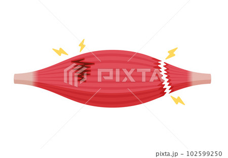 筋断裂 (肉離れ) の症状 ベクターイラスト (部分断裂・完全断裂) / 文字なし 102599250