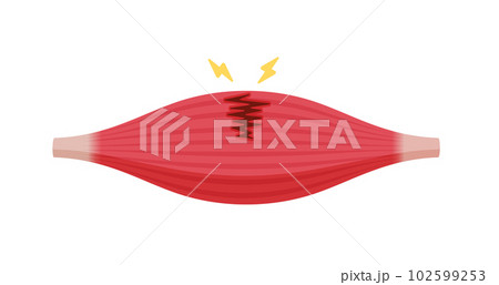 筋断裂 (肉離れ) の症状 ベクターイラスト (部分断裂) 102599253