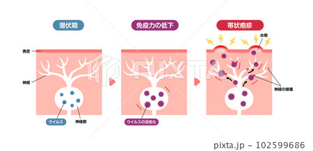帯状疱疹の発生メカニズム / 皮膚断面図 図解イラスト  102599686