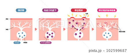 帯状疱疹の発生メカニズム / 皮膚断面図 図解イラスト (帯状疱疹後神経痛) 帯状疱疹の発生メカニズム / 皮膚断面図 図解イラスト (帯状疱疹後神経痛) 102599687