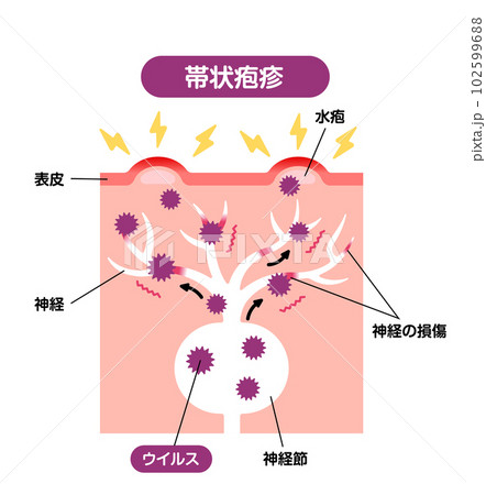 帯状疱疹の発生メカニズム / 皮膚断面図 図解イラスト 帯状疱疹の発生メカニズム / 皮膚断面図 図解イラスト 102599688