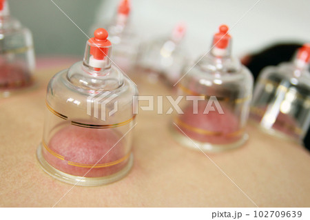 Concept image of cupping and medicine, a traditional oriental medicine 102709639