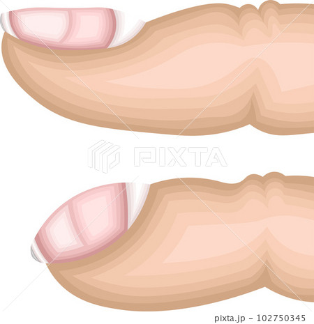 ばち指　構造　イラスト 102750345
