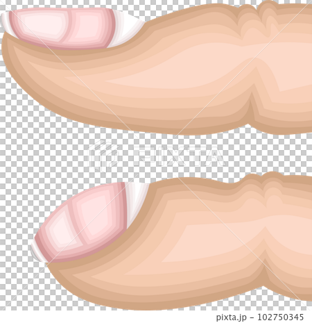 ばち指　構造　イラスト 102750345