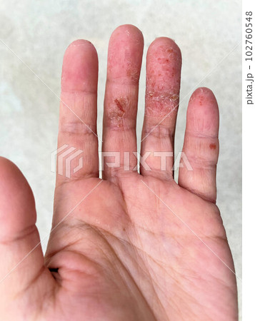 アトピー性皮膚炎患者の、汗疱疹の悪化による皮膚の裂け、手湿疹・手荒れ 102760548