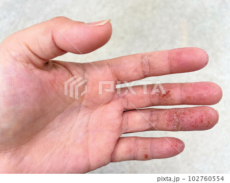 アトピー性皮膚炎患者の、汗疱疹の悪化による皮膚の裂け、手湿疹・手荒れ アトピー性皮膚炎患者の、汗疱疹の悪化による皮膚の裂け、手湿疹・手荒れ 102760554