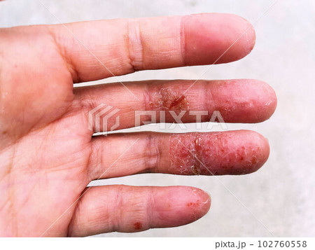 アトピー性皮膚炎患者の、汗疱疹の悪化による皮膚の裂け、手湿疹・手荒れ 102760558