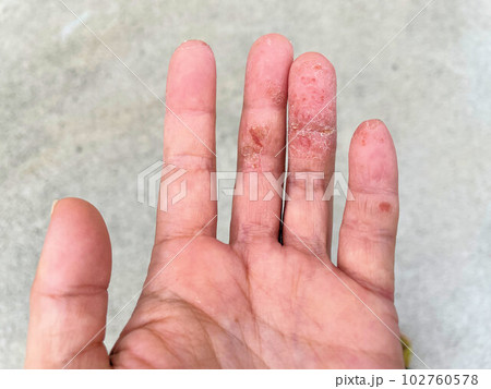 アトピー性皮膚炎患者の、汗疱疹の悪化による皮膚の裂け、手湿疹・手荒れ アトピー性皮膚炎患者の、汗疱疹の悪化による皮膚の裂け、手湿疹・手荒れ 102760578