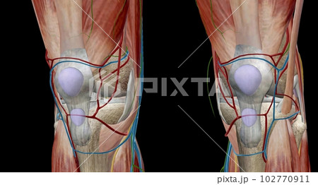 The knee is the largest and most complex joint in the body that holds the thighbone, shinbone, and kneecap together. 102770911