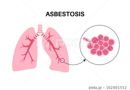 Asbestosis lung disease 102801552