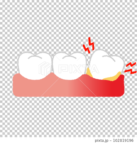 歯槽膿漏のイラスト 102819196