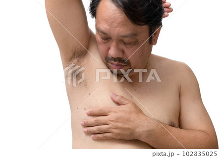 Close up the skin tags on man's skin under the armpits and sides of the body isolated on white Close up the skin tags on man's skin under the armpits and sides of the body isolated on white 102835025