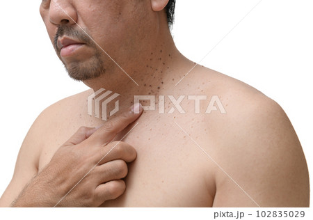 middle age senior man point to skin tags or acrochordon on his neck middle age senior man point to skin tags or acrochordon on his neck 102835029
