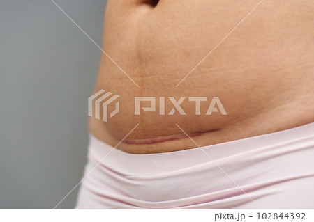 close up belly of woman with c-section scar of caesarean 102844392
