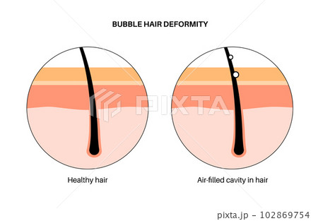 Bubble hair deformity 102869754
