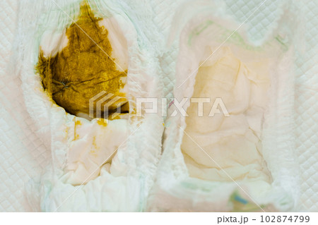 dirty baby diaper with urine and stained feces 102874799