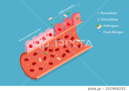3D Isometric Flat Vector Conceptual Illustration of Leaky Gut Syndrome 102906282