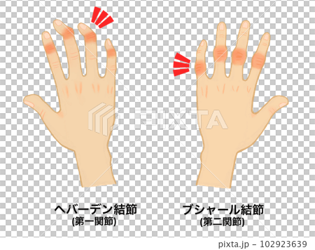 hand joint disease 102923639