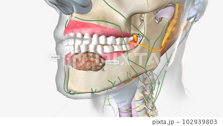 Once a tumor has spread into nearby lymph nodes, it is considered a stage three cancer. Once a tumor has spread into nearby lymph nodes, it is considered a stage three cancer. 102939803