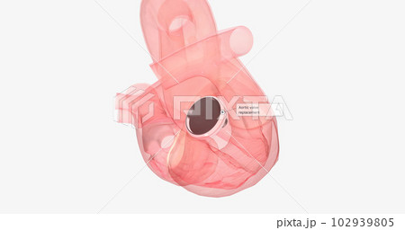 The damaged aortic valve may also be replaced with a mechanical or a biological tissue valve. 102939805