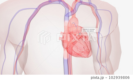 Using a local anesthetic, a catheter is inserted into a vein or artery near the groin. 102939806