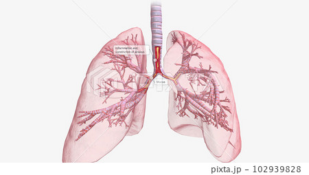 Inflammation and constriction of airways Inflammation and constriction of airways 102939828