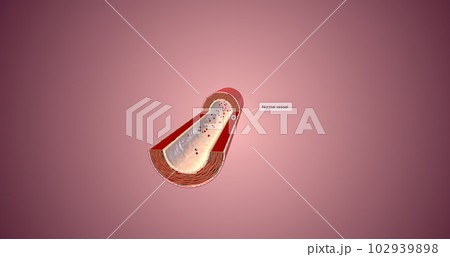 A healthy artery has supple and muscular walls that help blood flow. A healthy artery has supple and muscular walls that help blood flow. 102939898