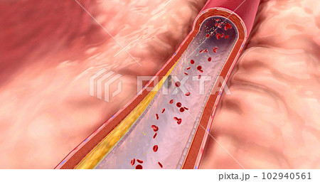 Atherosclerosis is the plaque buildup in the walls of the arteries. 102940561