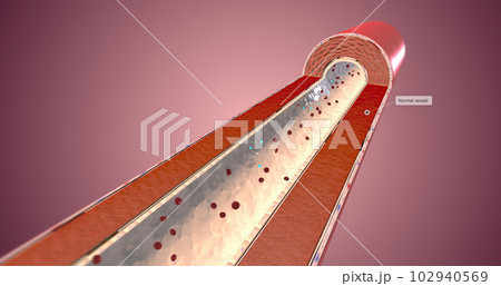 A healthy artery has supple and muscular walls that help blood flow. A healthy artery has supple and muscular walls that help blood flow. 102940569