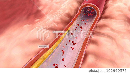 Atherosclerosis is the plaque buildup in the walls of the arteries. Atherosclerosis is the plaque buildup in the walls of the arteries. 102940573